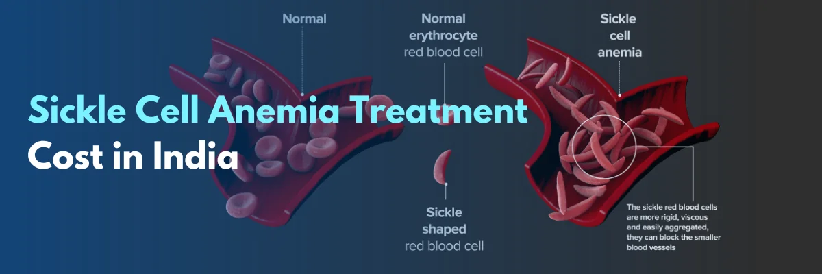 Sickle Cell Anemia treatment Cost in India