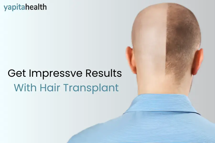 Hair Transplant Results: Before & After Transformations