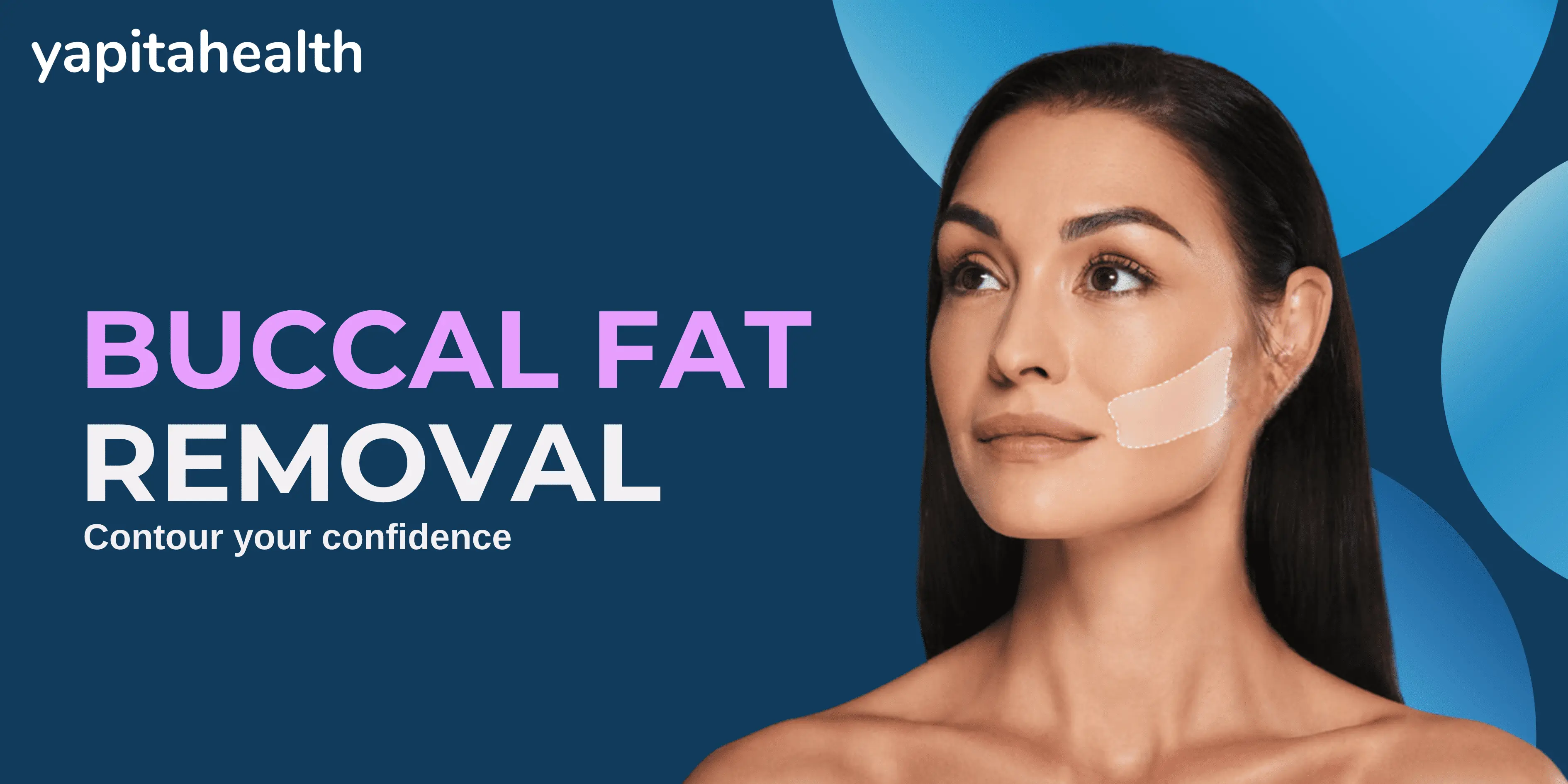 buccal fat removal before and after
