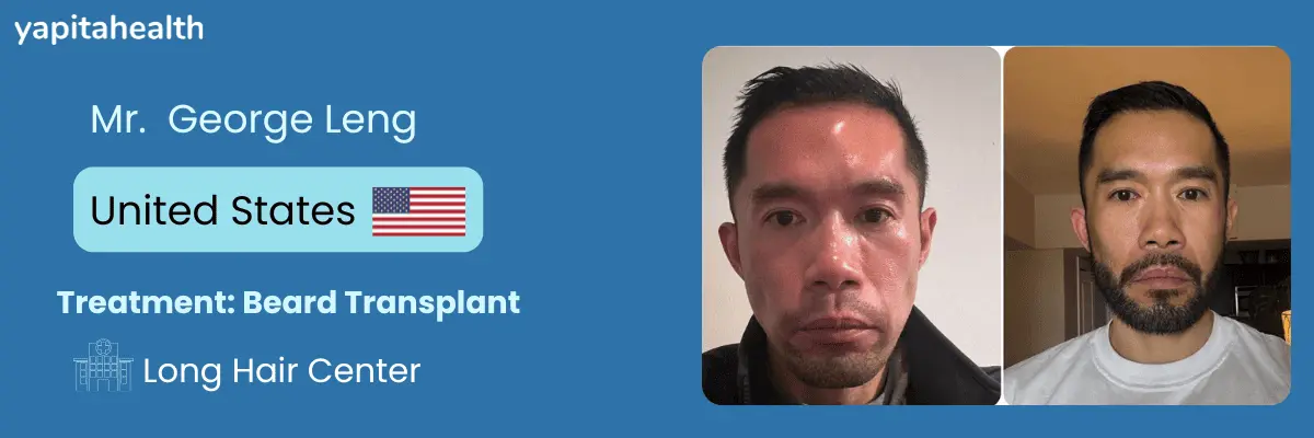 George Leng's Beard Transplant Journey - Yapita Health