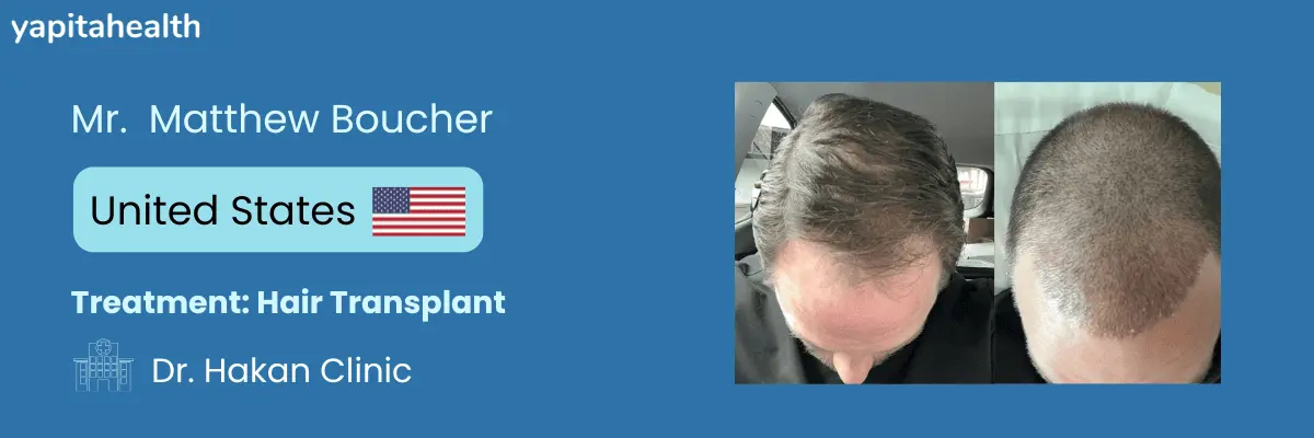 Matthew Boucher's Hair Transplant Success Story - Yapita Health