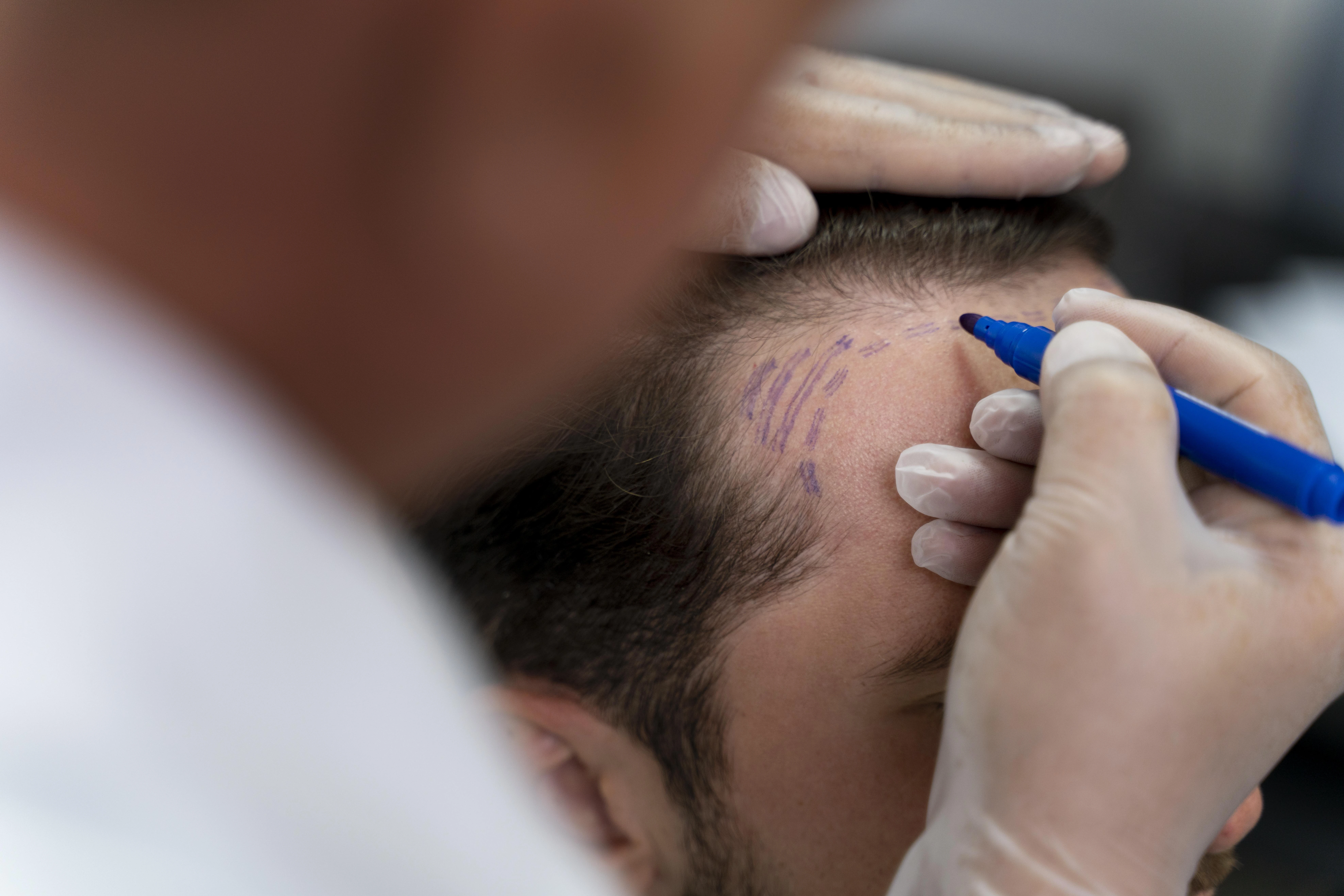 hair transplant in sao paulo