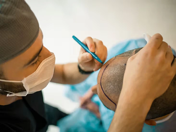 hair transplant in Denver