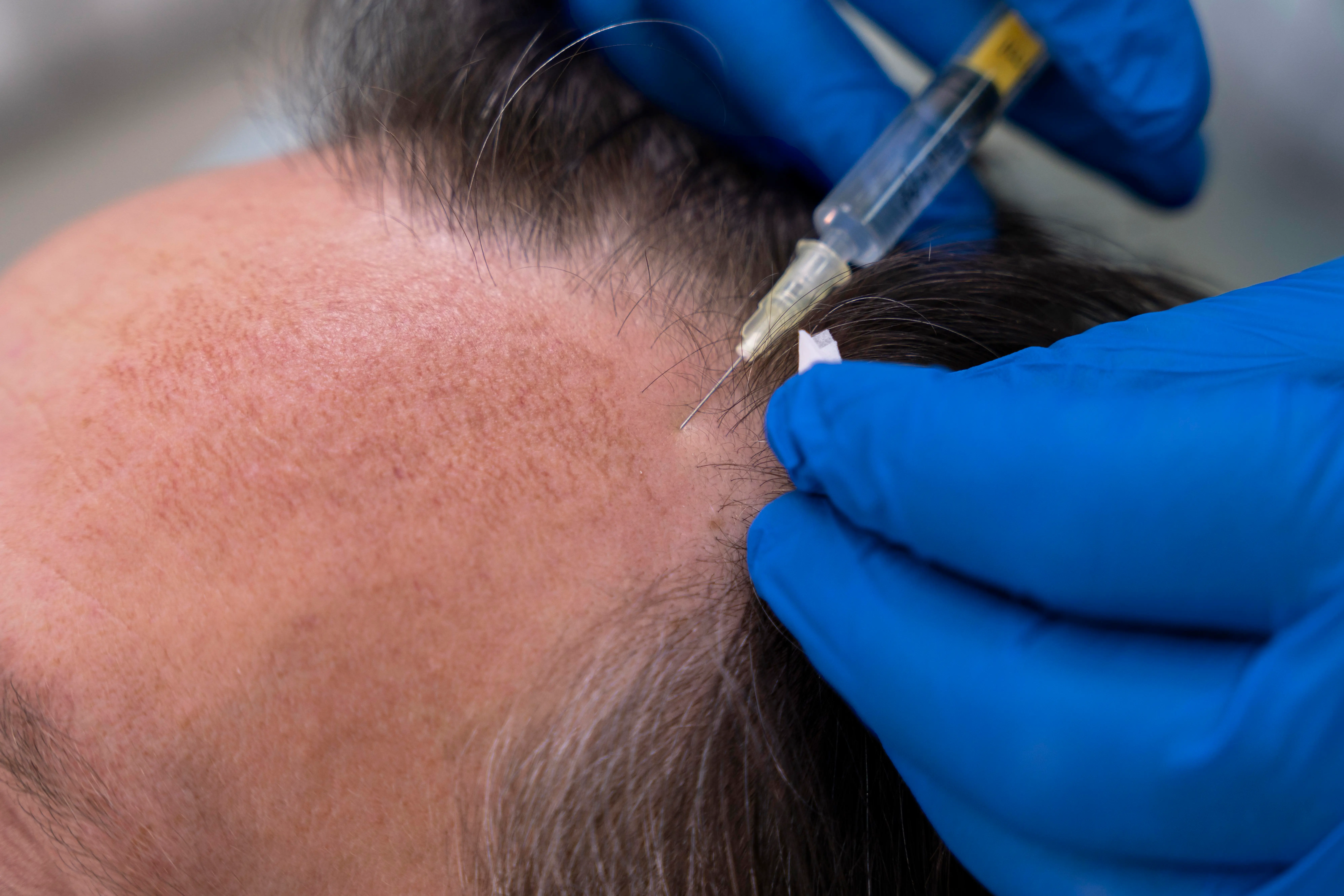 hair transplant in Florida