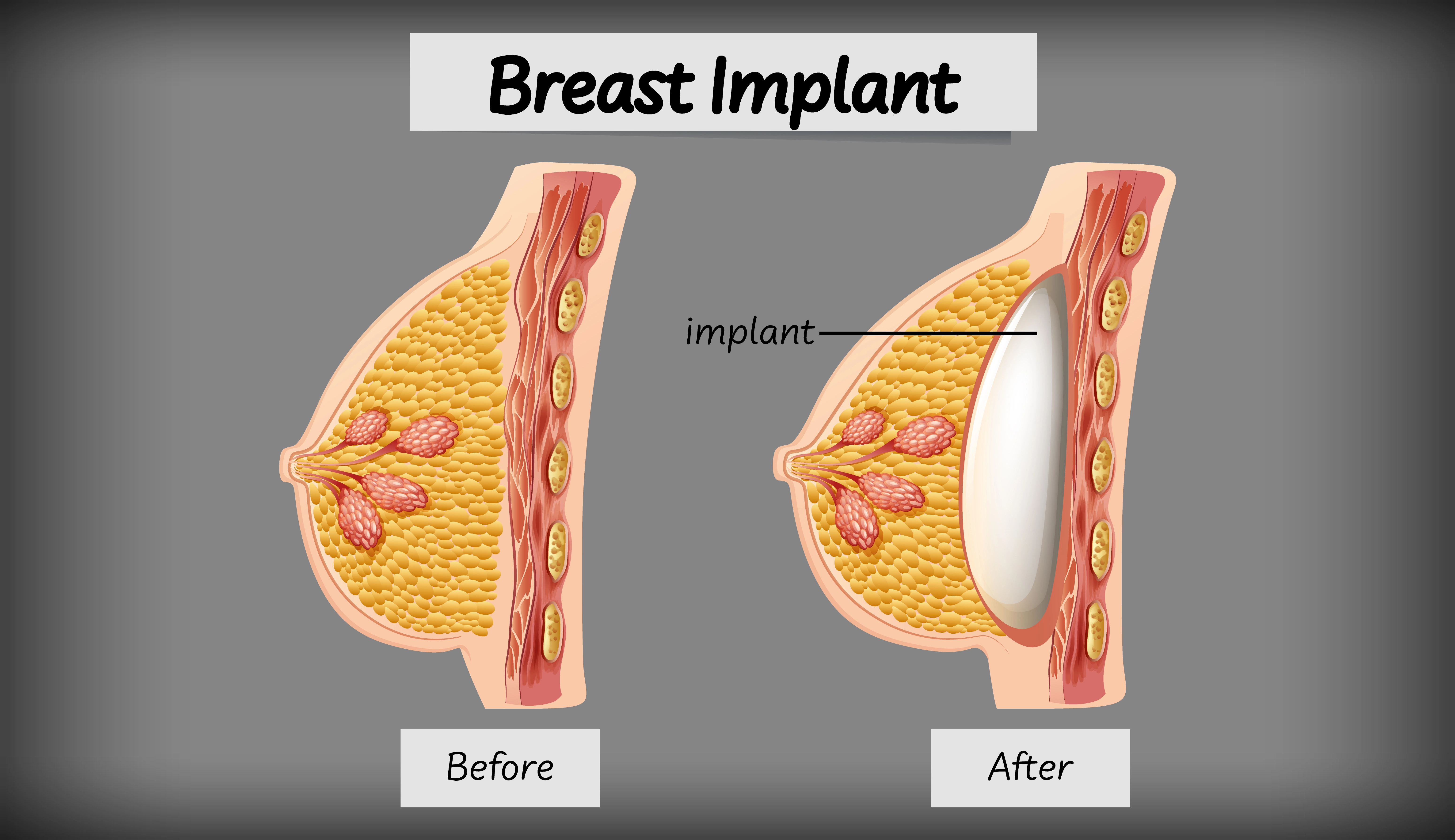 breast augmentation before and after