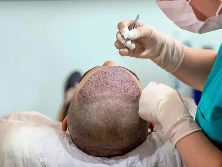 hair transplant in Greece