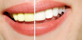 teeth-whitening