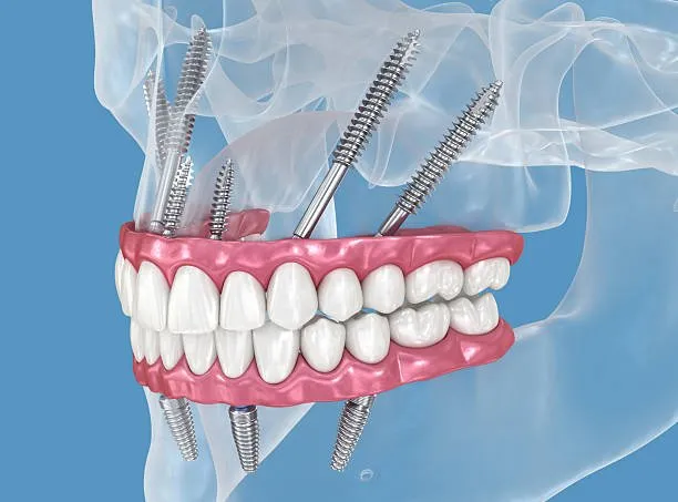zygomatic implants help patients avoid bone grafting