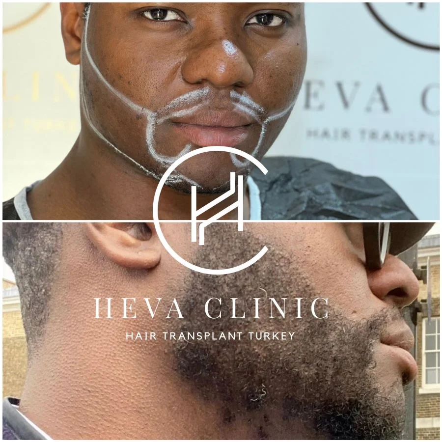 Afro-Barttransplantation Heva Clinic 2800 Grafts
