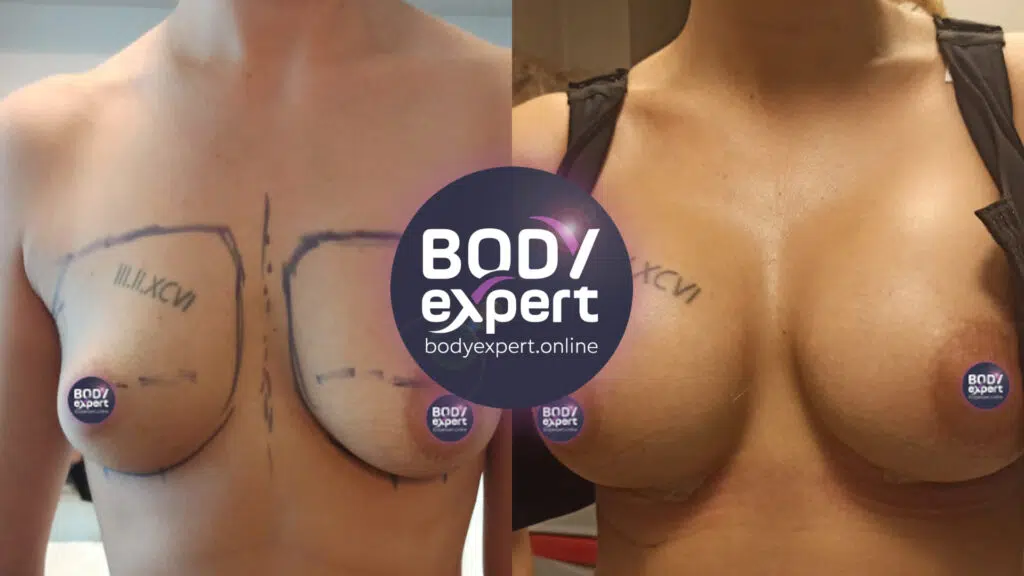 breast augmentation before and after body expert clinic