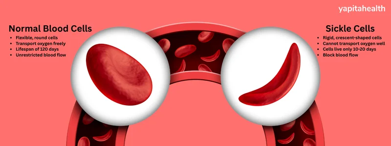 sickle cell anemia has sickle-shaped hemoglobin which restricts oxygen transport