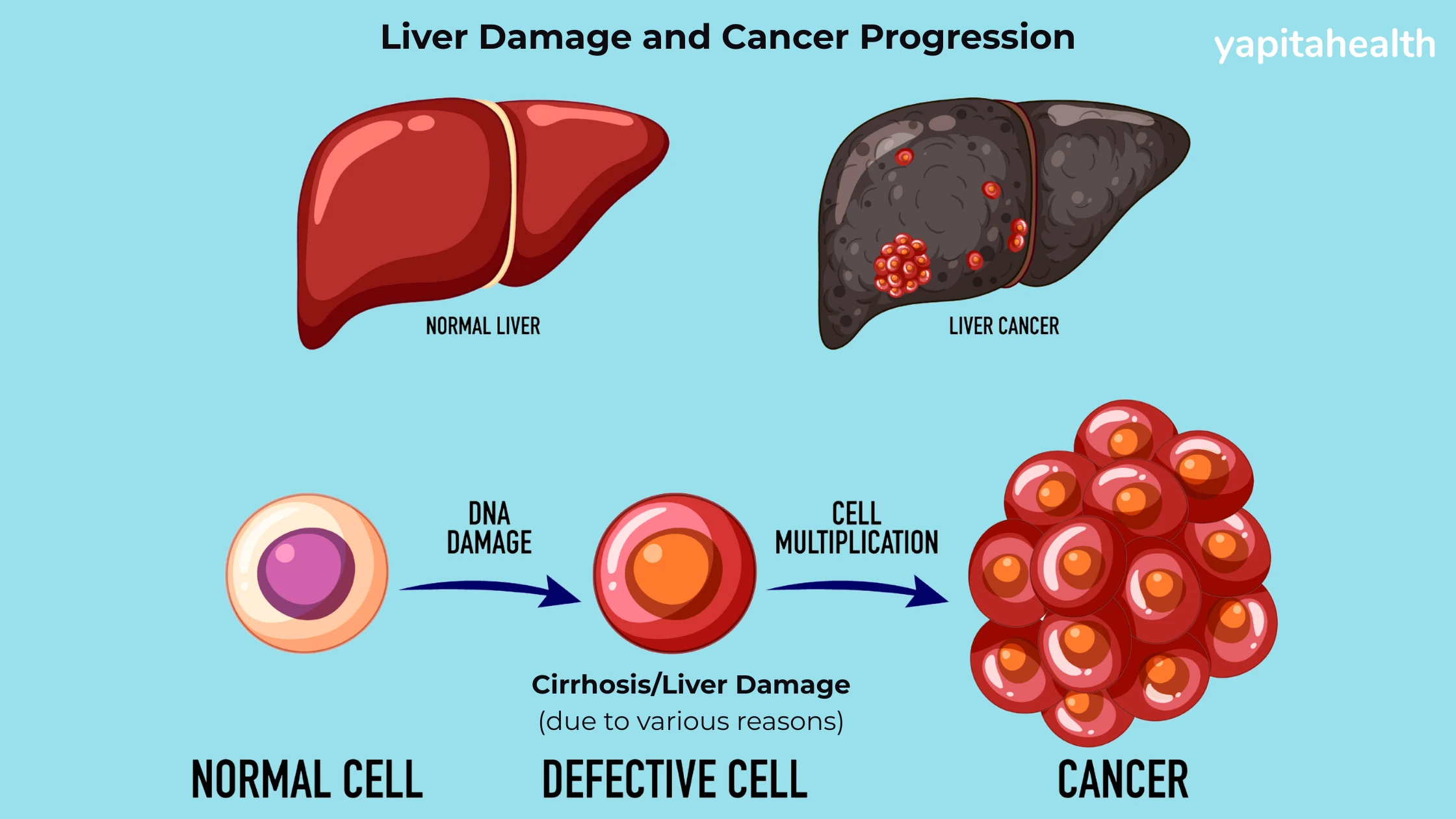 liver damage and cancer progression