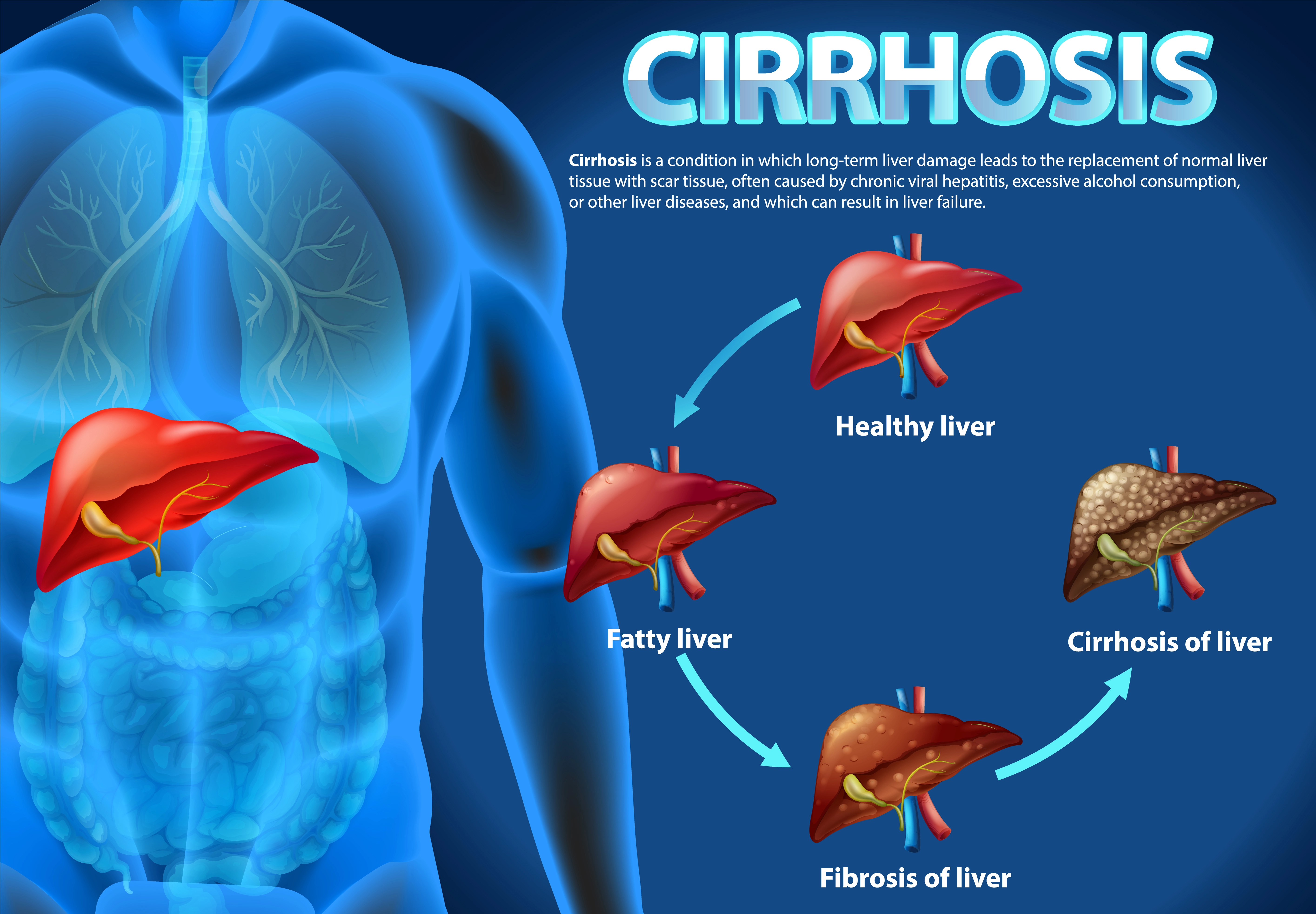 liver transplant can help in case of liver cirrhosis 