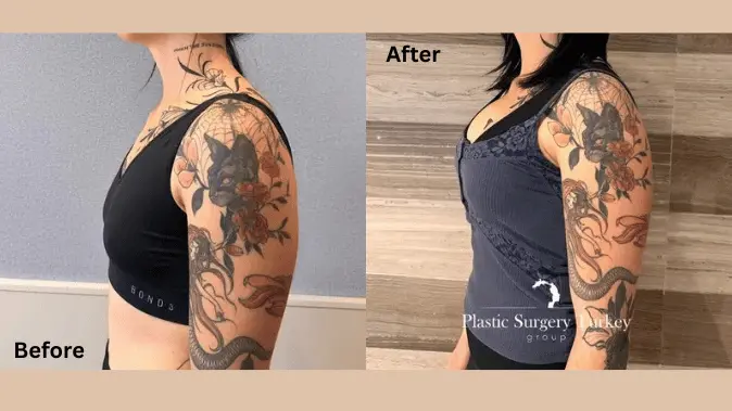 Plastic surgery Turkey clinic before-after