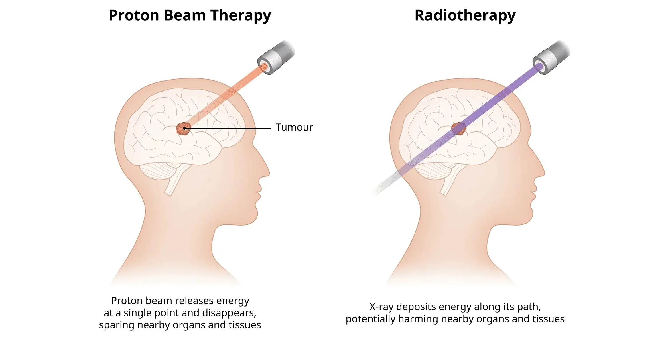proton beam therapy is a highly precise radiation therapy that prevents damage to essential organs