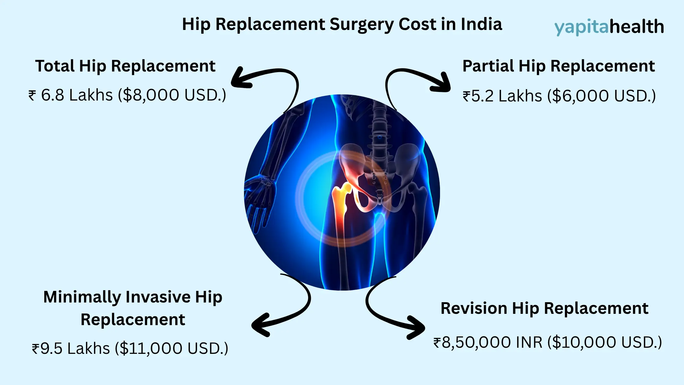 Hip replacement surgery cost in India