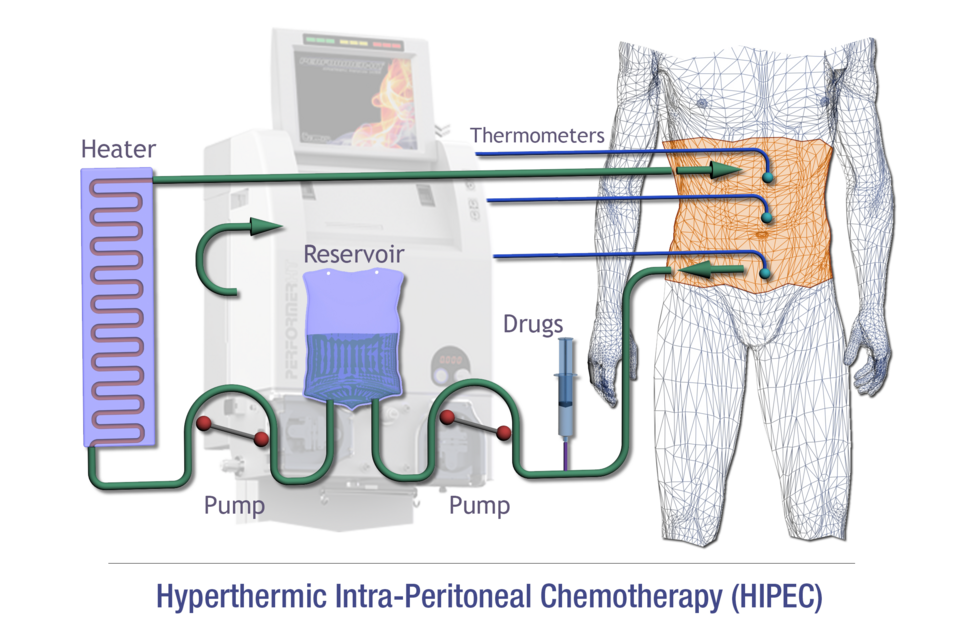 HIPEC for cancer treatment combines heat with chemotherapeutic drugs that destroy cancer cells