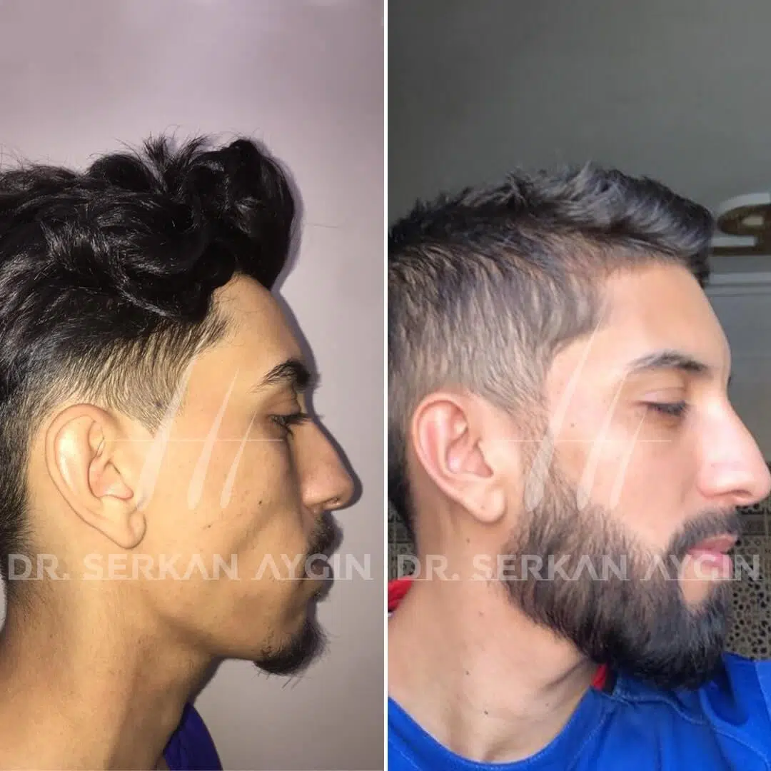 Barttransplantation durch Serkan Aygin Clinic