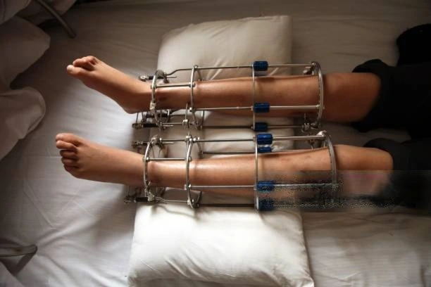 external fixator limb lengthening procedure for height increase